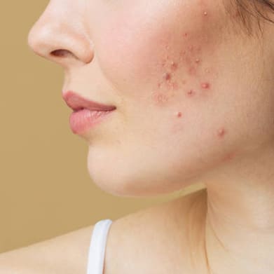 Acne Scars