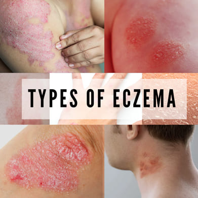 ECZEMA