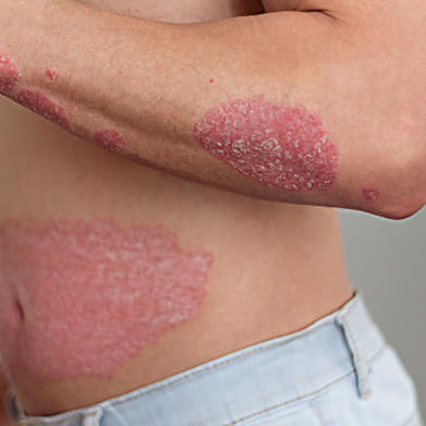 Psoriasis