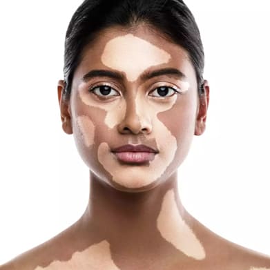 Vitiligo Surgery