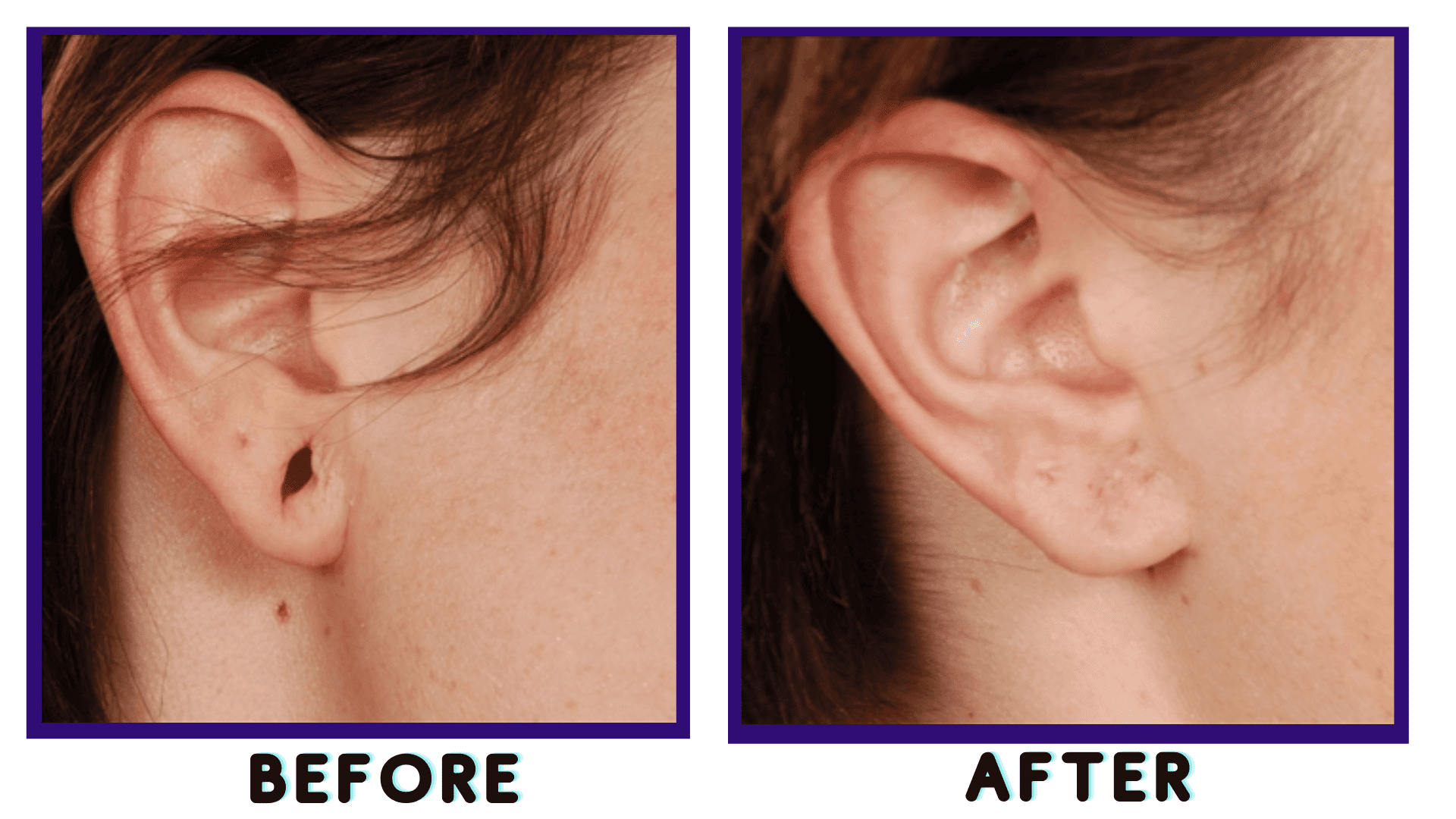 Ear Lobe Repair