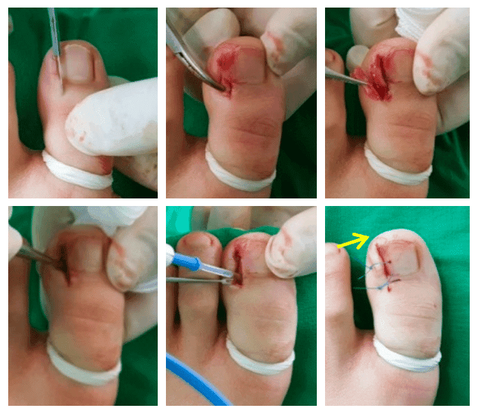 Nail Surgery