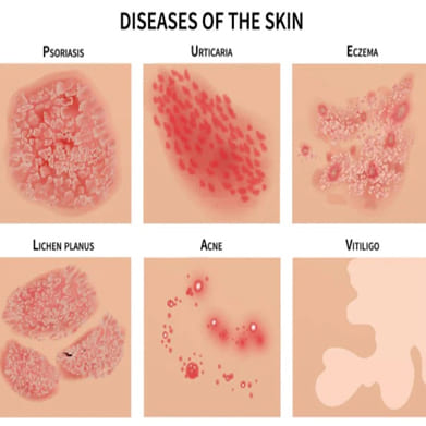 Skin Infection